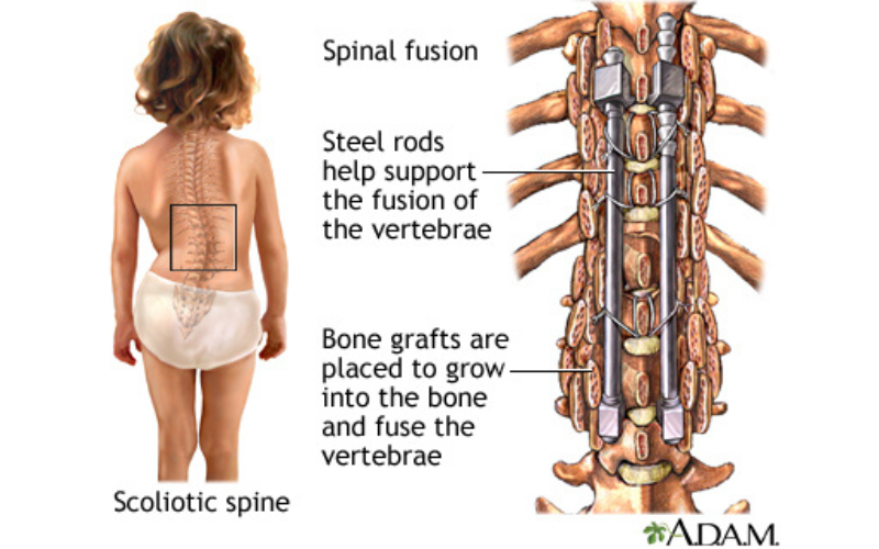 scoliotic spine and spinal fusion of back braces